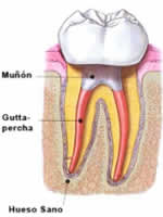 endodonciadenthales