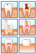 endodoncia_denthales