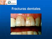 fracturadental