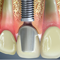 implante_dental_unitario