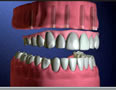 protesis_superior_sobre_implantes_dentales