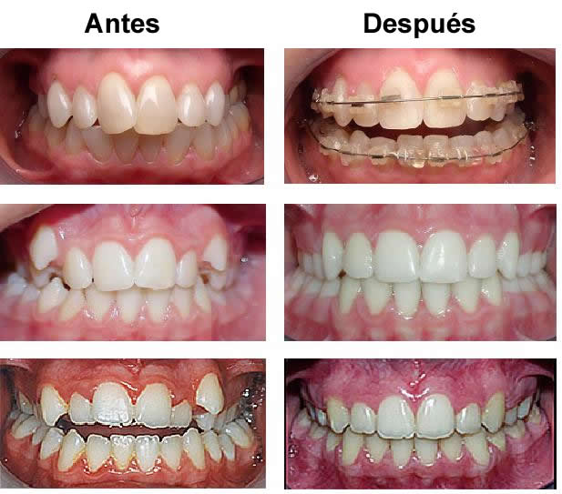 ortodonciaantesydespues