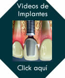 video_implantes_dentales
